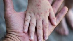 Kemenkes Terbitkan SE Kewaspadaan Campak, RS Diminta Siapkan Ruang Isolasi