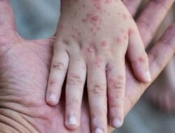 1.757 Suspek Campak di Jateng Awal 2026, Lima Daerah Masuk Indikasi KLB